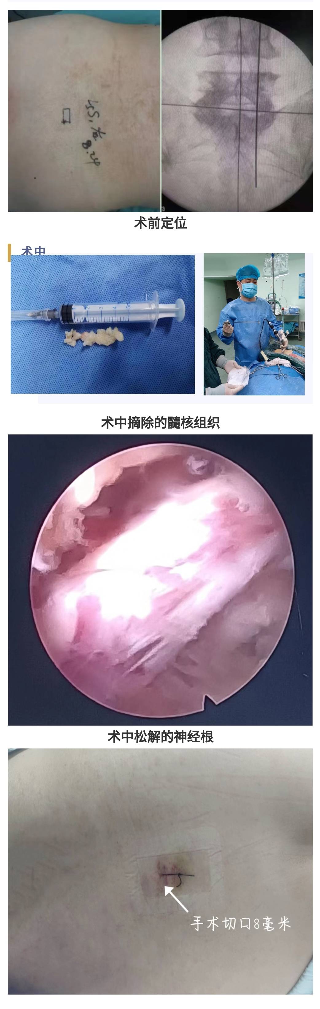 系列|PEID治疗巨大腰椎间盘突出症 ——脊柱微创手术系列