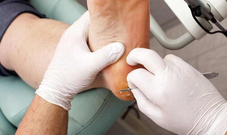 渔网|若脚上出现4个信号，肝已“烂如渔网”，尽快自查，不要忽视！