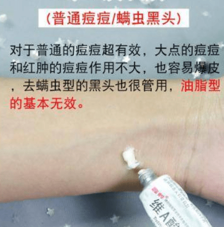 方法|脸上长痘痘的原因？怎么去痘痘的方法最快最简单（美容师分享）