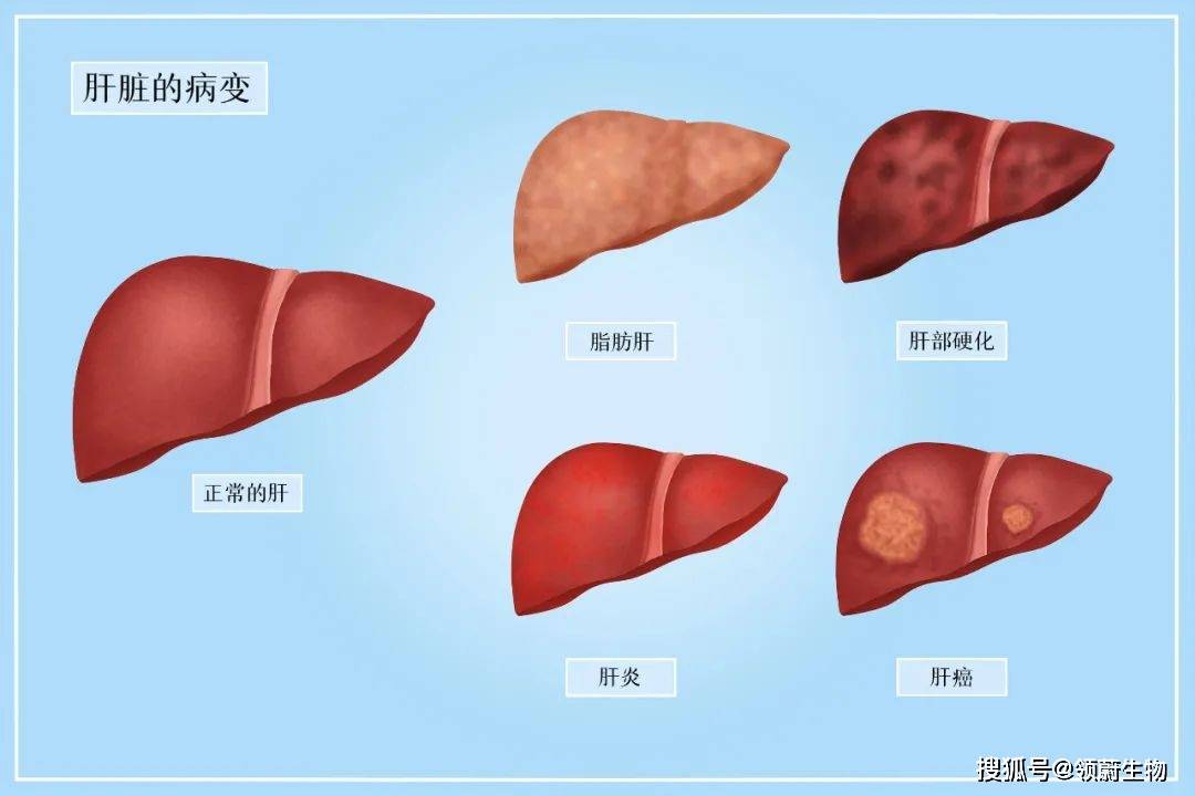 横膈膜|得了“肝硬化”，还能实现逆转吗？
