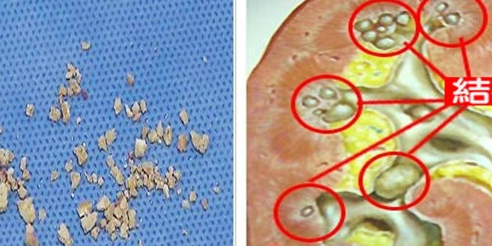 因为|烧自来水后的“水垢”,长期喝会得肾结石?答案会令你很意外!