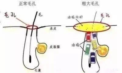 毛孔|把脸打湿，就上洗面奶？做不到“这几点”，别怪毛孔粗大易长痘