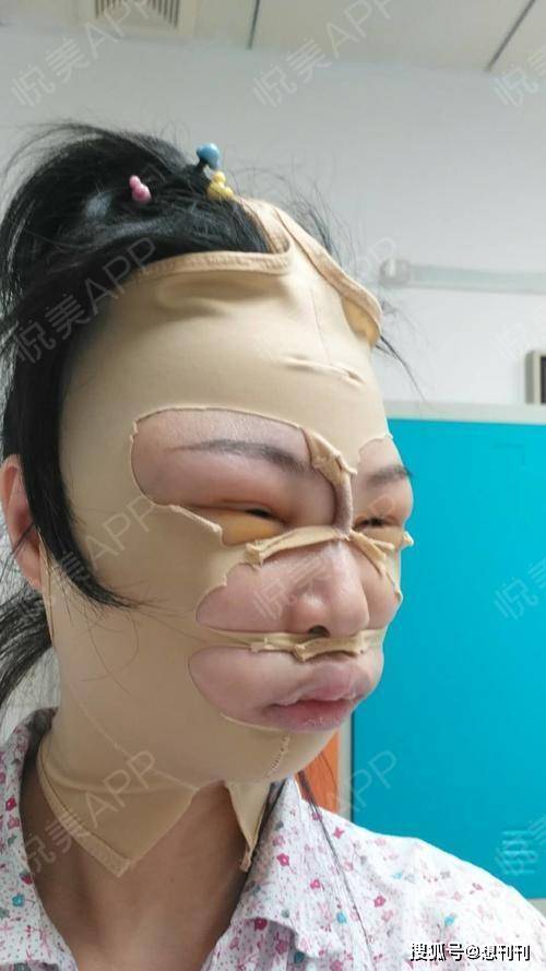 下巴|那些一刀切削骨的明星还好吗？后遗症一大堆，小方脸成最大赢家