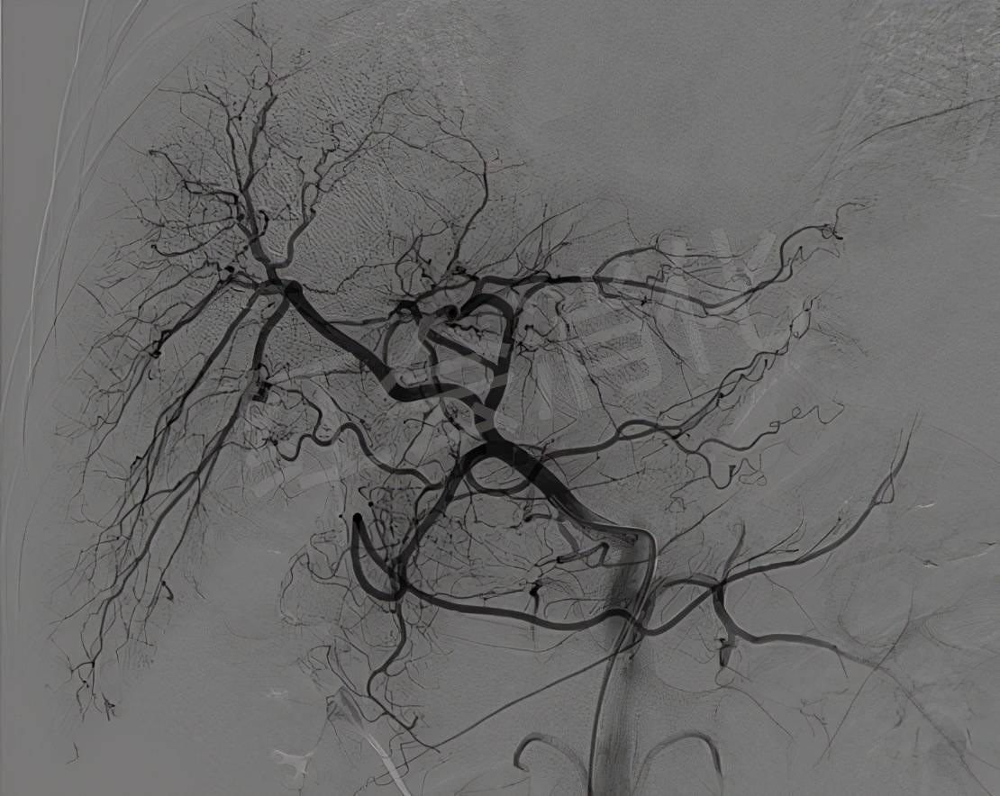 血管|西安市红会医院 让肿瘤“饿”死的TACE术 为两例中晚期肝癌排忧