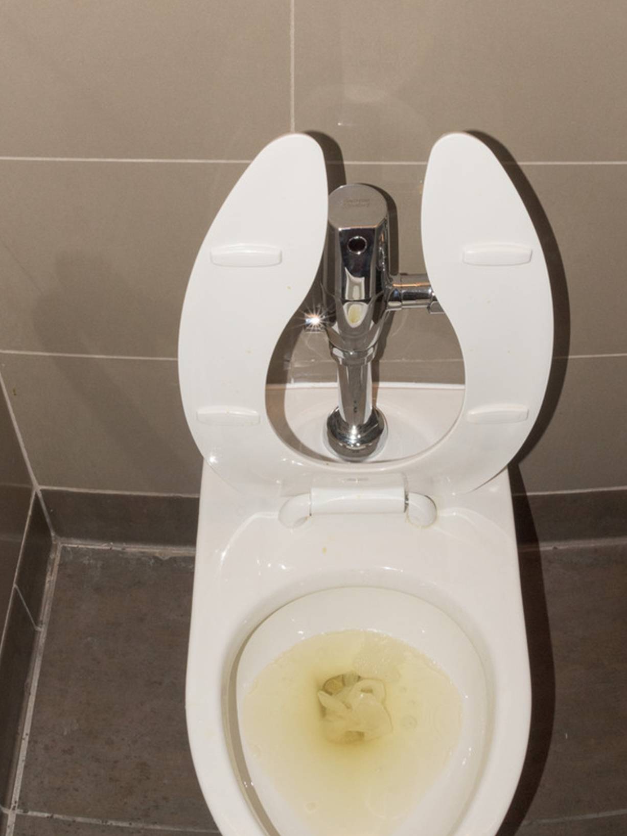 肾脏|26岁男子确诊肾衰竭,竟是“拖”出来的,肾病这4个信号不可忽略