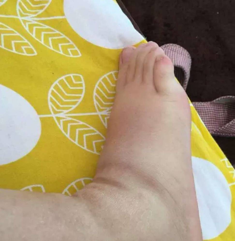 症状|尿酸高的人,若有这3种症状,肾脏可能已受牵连,早发现早治疗