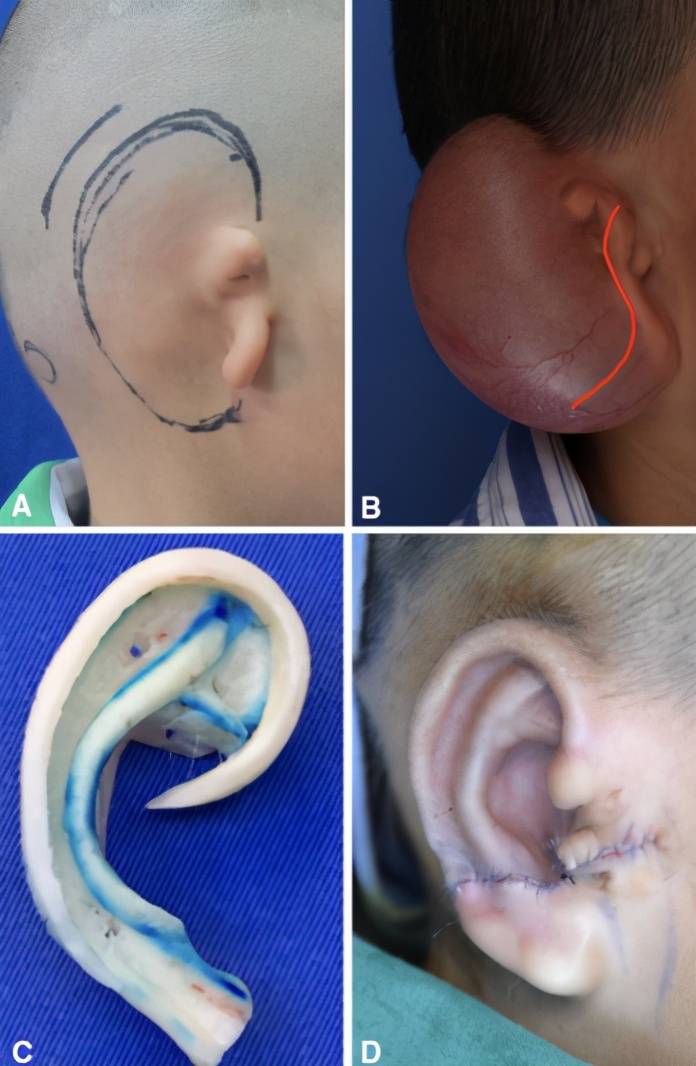 再造耳朵余文林:全扩张法耳再造手术是如何完成的?_整形