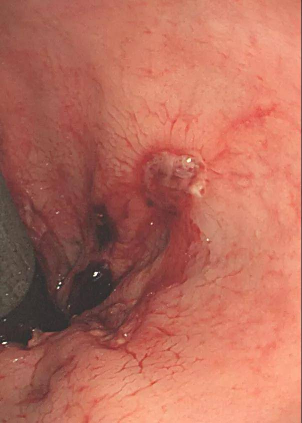 肛门口|20岁小伙因痔疮致贫血 近乎失了全身2/3血量