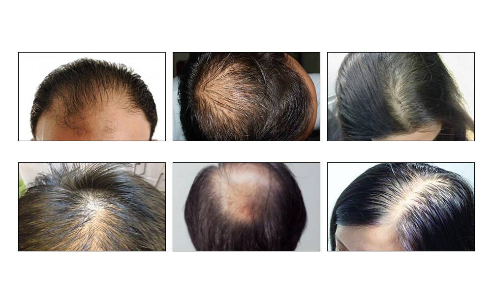 主力军|龙源：白领/蓝领成脱发主力军？用蓝色精灵/白马王子泡脚有用吗？