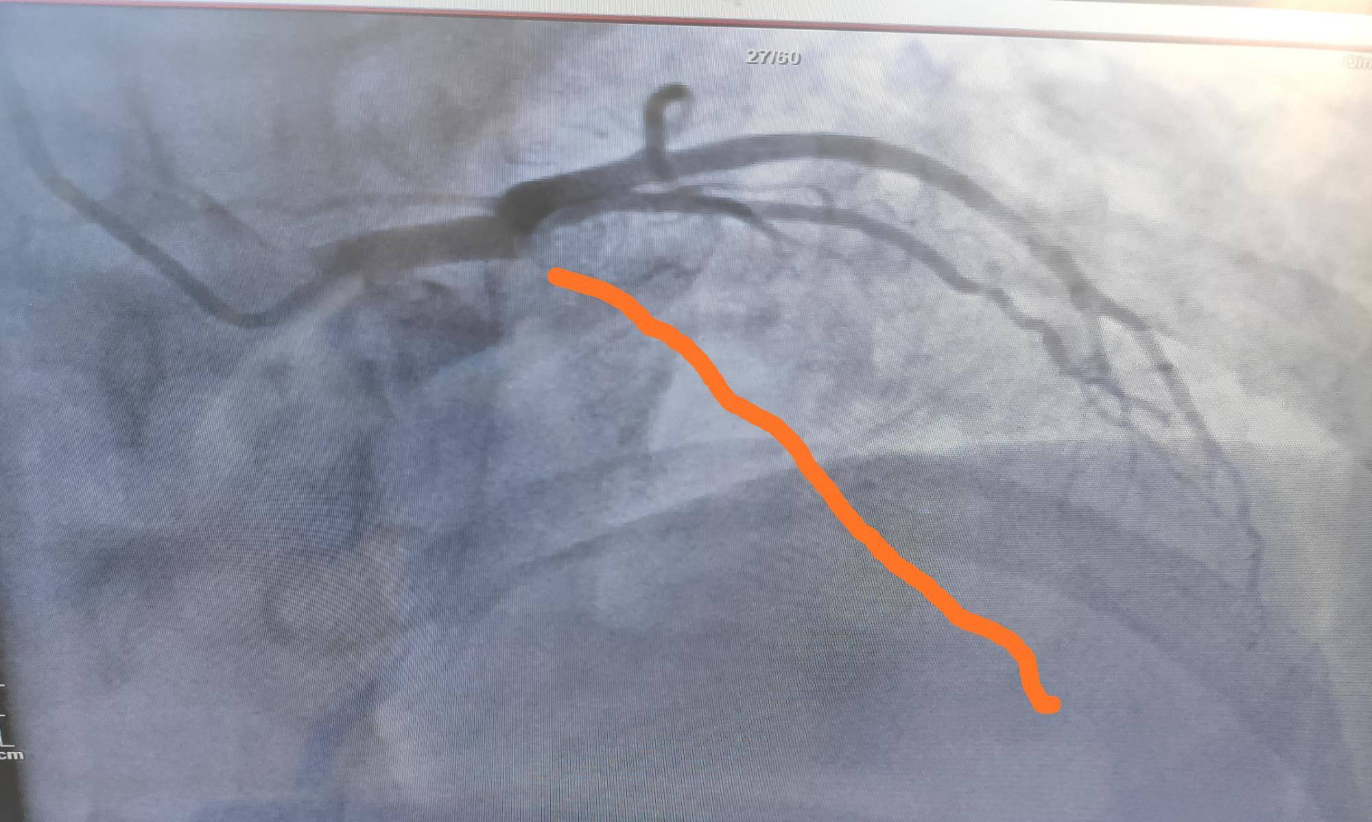 造影|45岁女性急性心梗，开始医生也有所怀疑，最后找到了原因