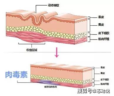 动态型|除皱篇丨川字纹形成原因以及改善方法，祛除恼人的皱纹！