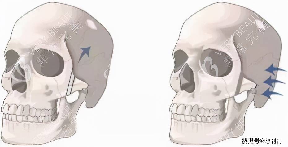 颧骨|做了颧骨内推的明星真的变美了吗？推平容易后悔难，后遗症一大堆