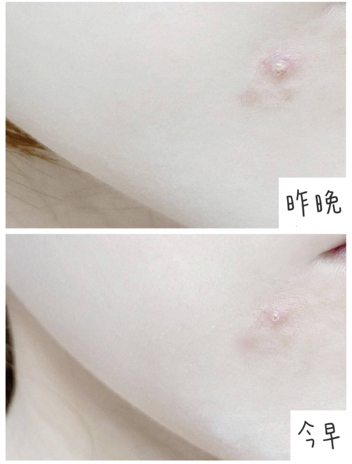 因为|对付痘痘就得少而精！