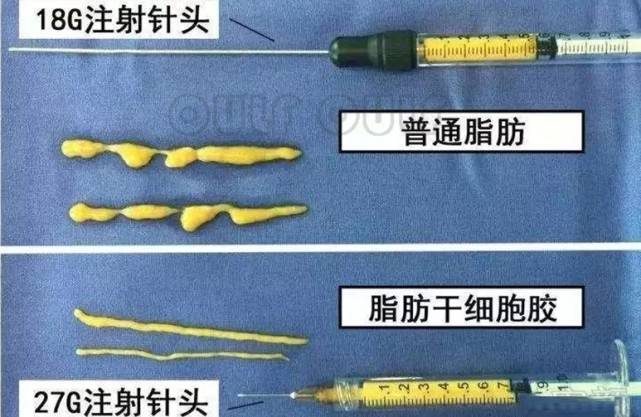 存活率|svf脂肪胶填充维持多久？脂肪胶填充面部多久能恢复自然？