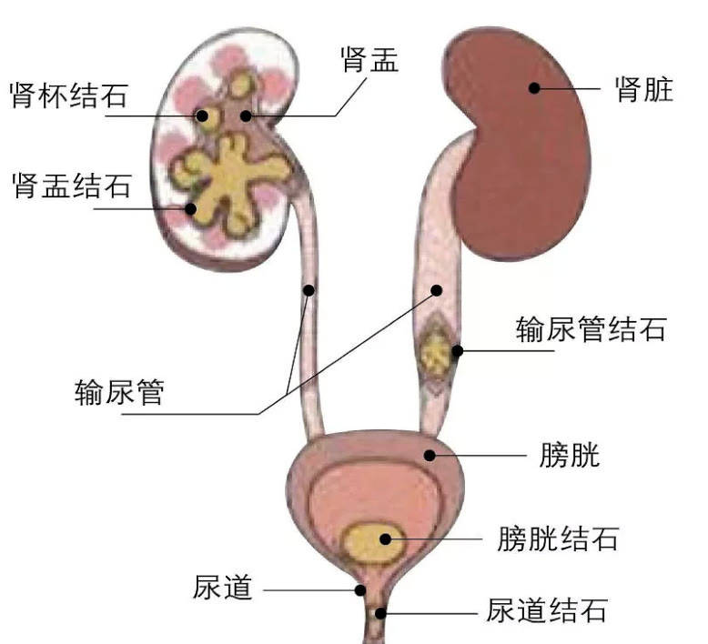 什么|肾结石是什么