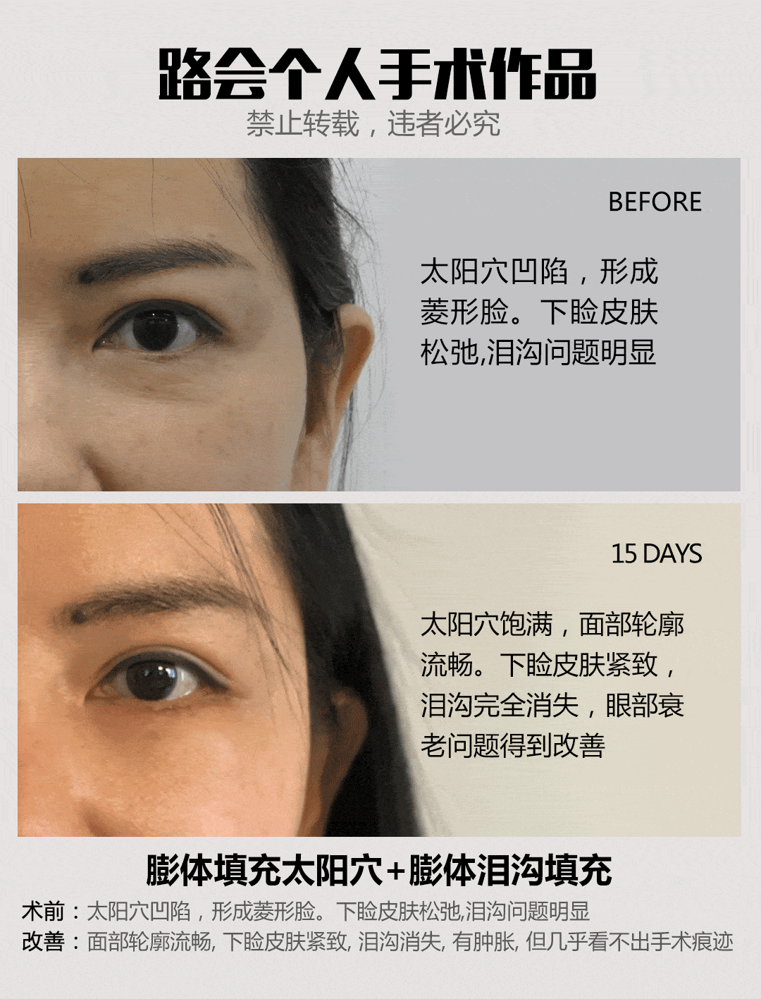 面部|为什么说年龄越大，越不建议做脂肪填充？(1) 头条文章