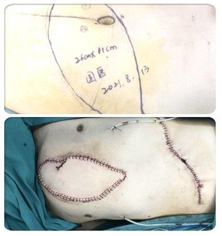 手术缝合后患者原先变形凸起的胸廓平复如故尊重民族信仰,铸就医患