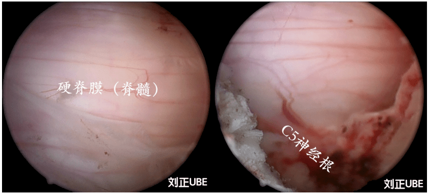 技术|颈椎问题，微创帮您解除困扰！