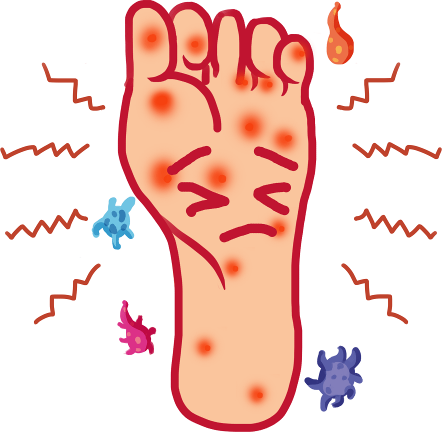 作为一种真菌感染导致的皮肤病,脚气的主要发作部位是足底和脚趾,通常