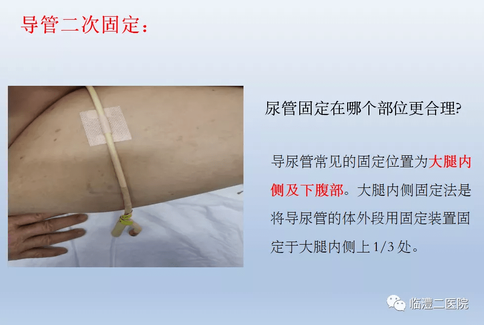 改善人:骨外科张梦,覃雅琦改善前:导尿管没有妥善固定,易脱出,管道