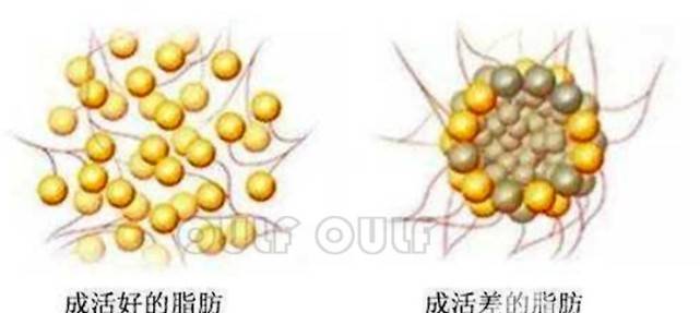 脸部|脂肪胶填充脸部可以维持多久？面部脂肪胶填充能管多久？想知道的看看
