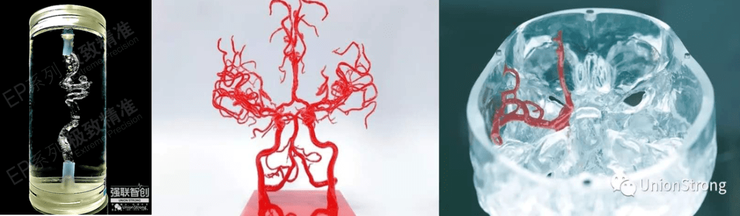 操作|颅内动脉瘤介入术前为什么要做模拟预演？