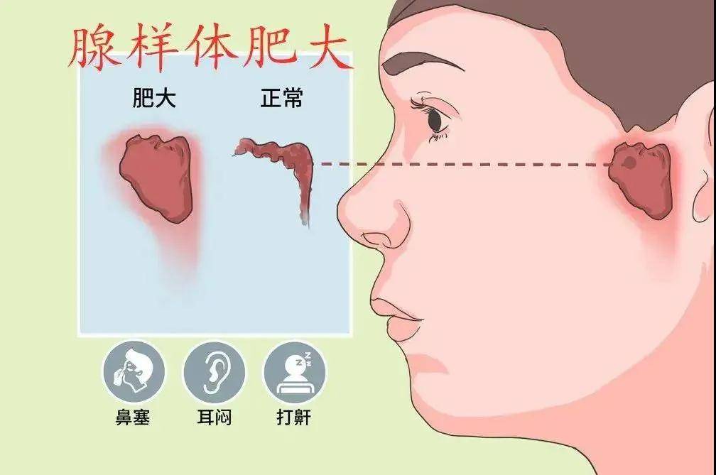 不知道你有没有检查,是否腺样体肥大,很多宝宝反复扁桃体发炎,上呼吸