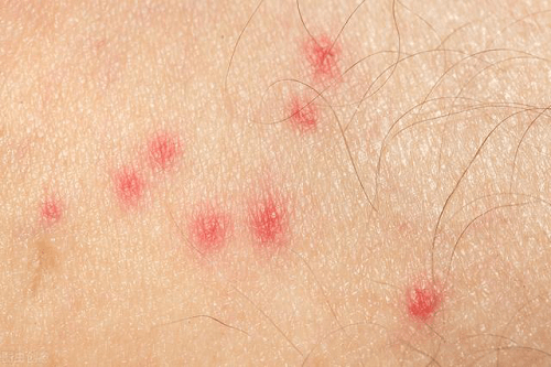 【秋季荨麻疹】秋季荨麻疹如何治疗_秋季荨麻疹的原因是什么
