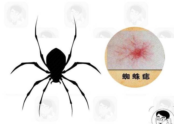 症状|身体出现5个异常信号,立即排查肝病,警惕肝硬化早期发生