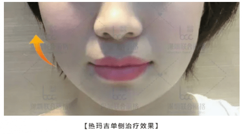 能量|热玛吉抗衰天花板，为何无法超越？