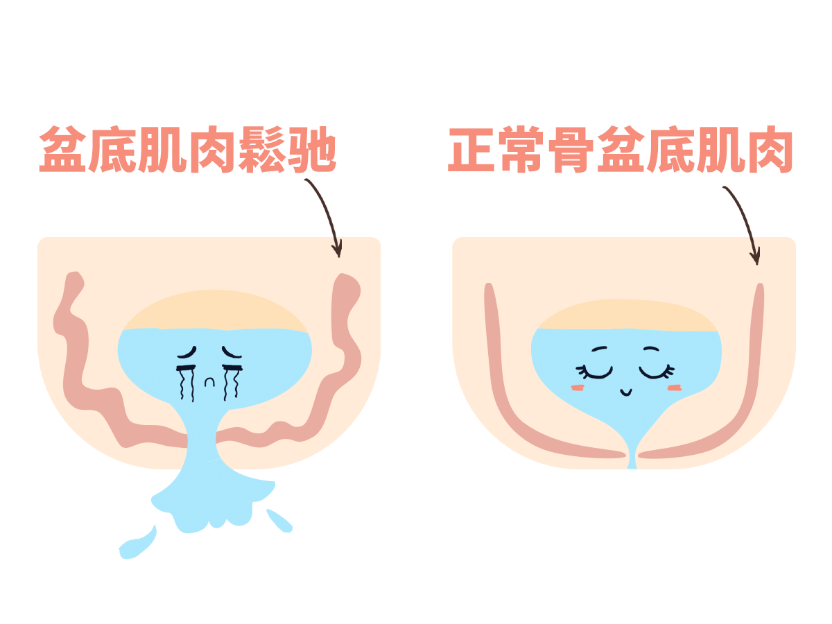 误区二:顺产才会损伤盆底肌,剖腹产不会不是的!