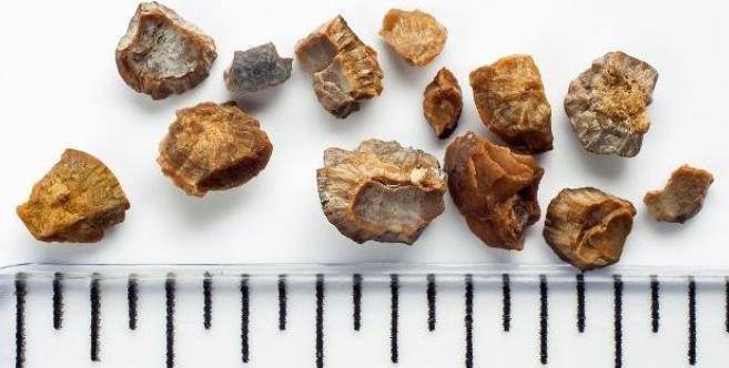 吸收率|肾结石是“吃”出来的？有一种食物平时常吃，可能有助于排出结石