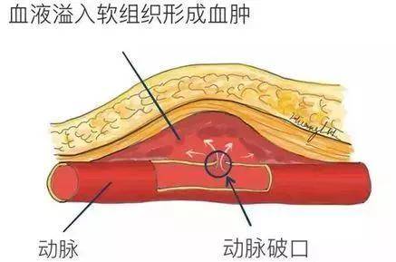 血管|神经血管介入中心联合超声科完成超声引导下凝血酶注射治疗假性动脉瘤