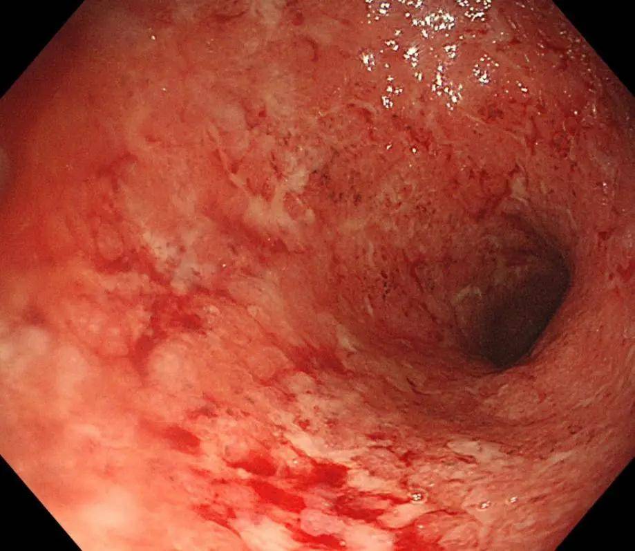 航天城|危言耸听？溃疡性结肠炎活不过10年！