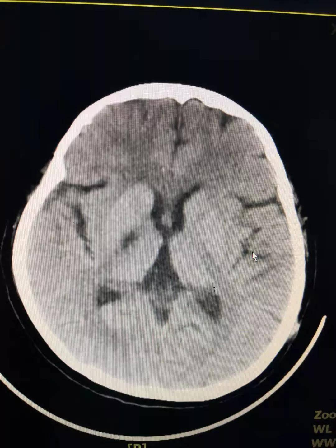 面神经|面瘫知多少？
