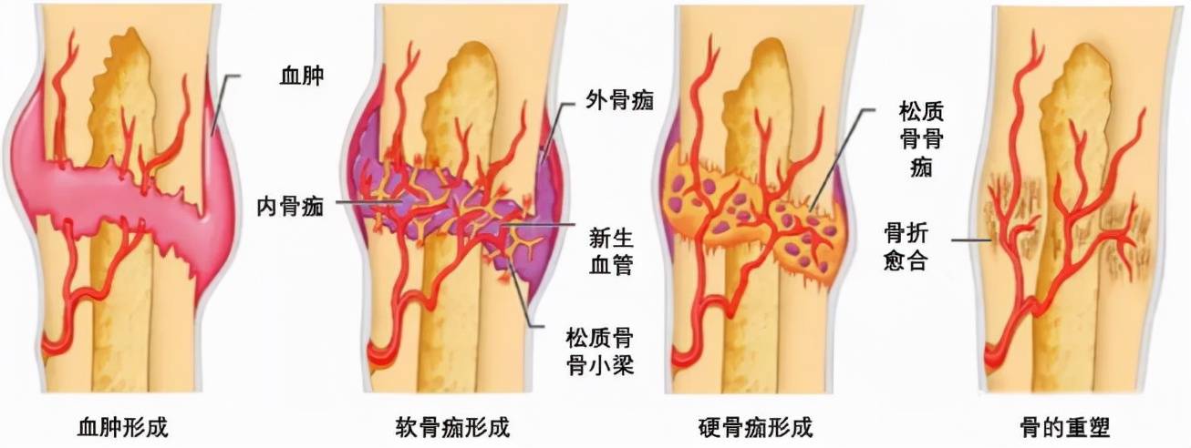 经过妥善复位及固定后,骨折处位于一个稳定环境,破骨细胞会清除坏死的