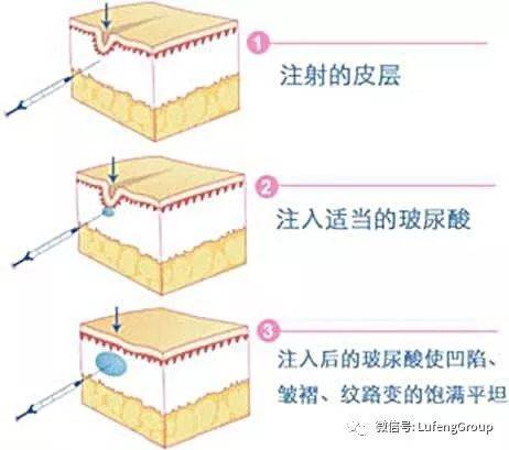 治疗95后都有颈纹了，“祖传颈纹”还有救吗？