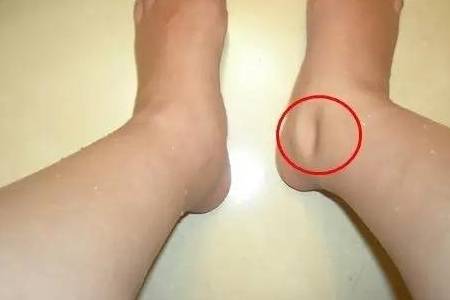 肾脏|比癌症还要痛苦的疾病，毁掉无数家庭