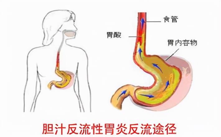 胆汁反流性胃炎有些症状