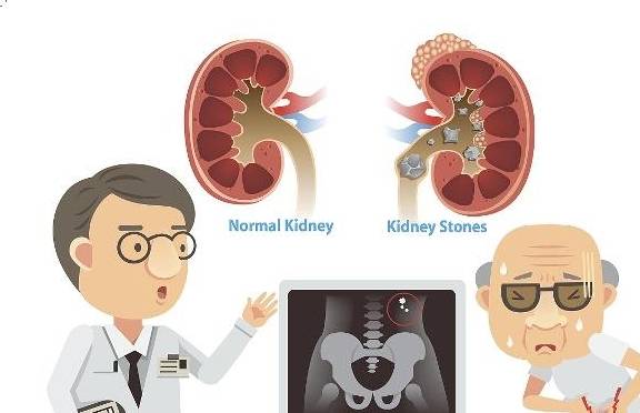 肾脏|哪些人群最容易患上肾结石？高浓度的尿酸通过肾脏，会导致什么？