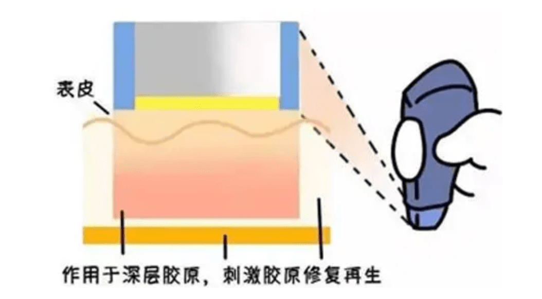 玛吉fotona4d和热玛吉哪个好，fotona和热玛吉的区别，你可以这样去选择