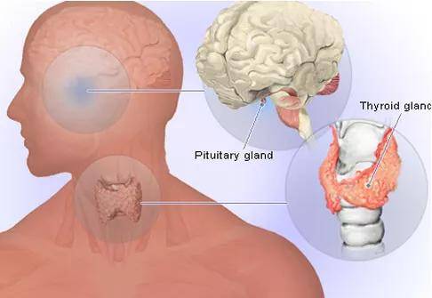 诊断|张先慧主任分享：容易被误诊的亚甲炎，你正处于哪个病情阶段？