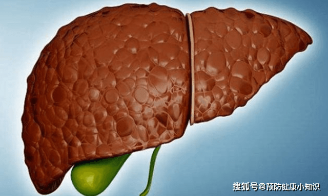 肝脏|肝癌早期不痛不痒,若出现“2黄1红”,别拖了,早检查肝CT