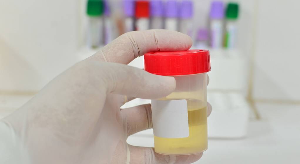 相关|尿检查出潜血而且有3个加号,是什么原因?今天,来告诉各位答案