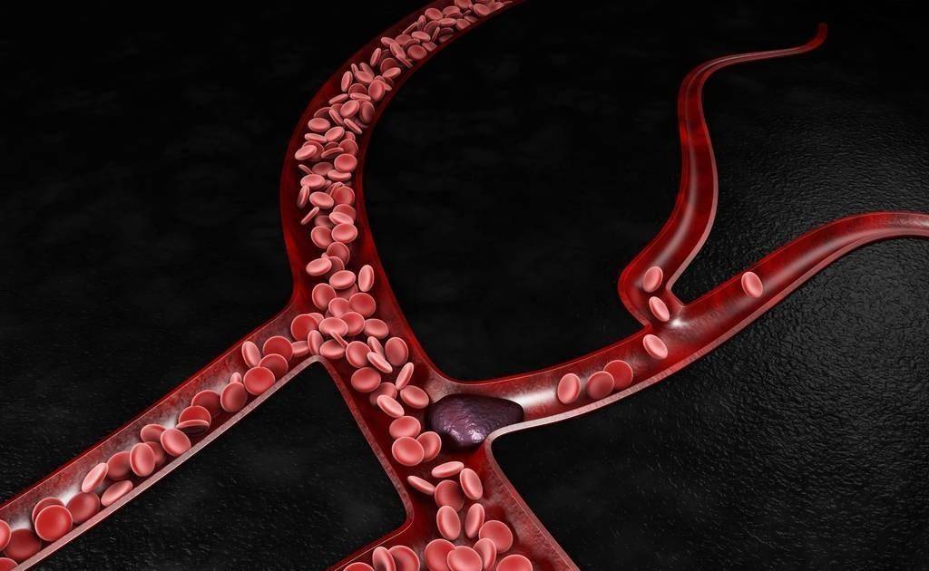 进行|腔隙性脑梗死也是脑梗死么?它们之间有什么区别,机理一样么