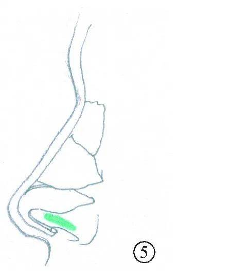 手术|如何do鼻子才能有好的效果？