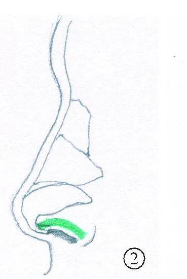 手术|如何do鼻子才能有好的效果？