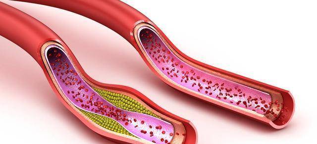 他汀|我对那个动脉有斑块的人说,最好不要停用他汀,原因是什么?