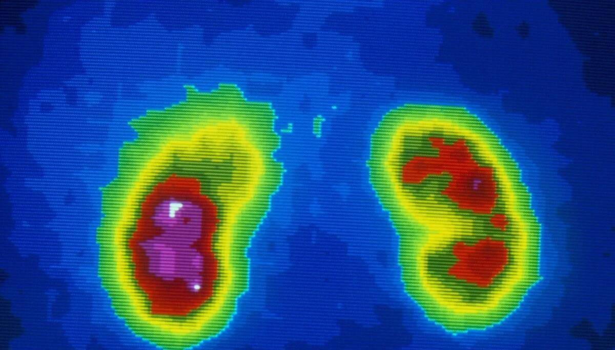 肾脏|那个吃“他汀”的人，为什么会急性肾衰竭？有什么方法能预防？