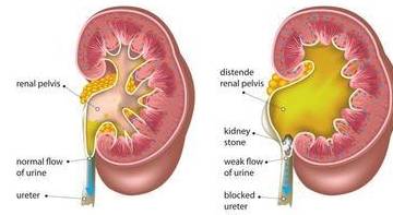 方法|肾积水应如何治疗,要分清楚这些才能有效治疗